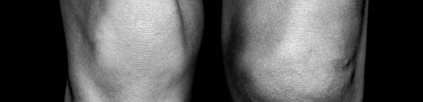 Knee Pain image Knee Pain image